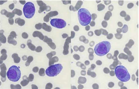 Morphology of circulating blast cells (May-Grünwald-Giemsa; x1,000). | Download Scientific Diagram