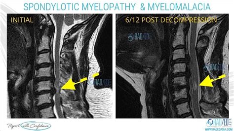 SPONDYLOTIC MYELOPATHY vs MYELOMALACIA: NO MORE CONFUSION - Radedasia