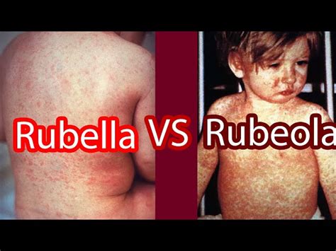 Rubella Rash