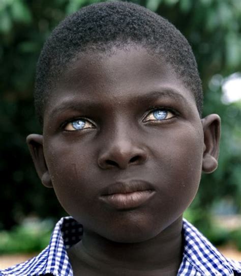 BLACKS WITH BLUE EYES: NATURAL PHENOMENON OR GENETIC MUTATION??