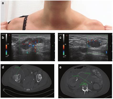 Cervical Lymph Nodes Ultrasound | Images and Photos finder