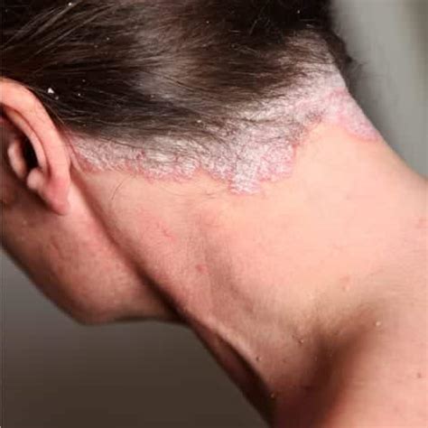 Scalp Psoriasis, Itchy Scalp, Dry Scalp, Tel. Free Advice Line Now | Holborn Hair & Scalp Clinic