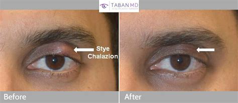 Eyelid Chalazion Surgery Before and After Gallery | Taban MD