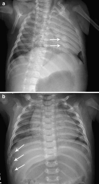 Acute rib fracture diagnosis in an infant by US: a matter of child protection | SpringerLink