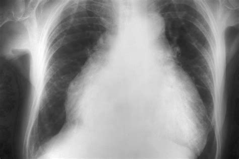 Cardiomegaly: symptoms, congenital, treatment, diagnosis by X-ray