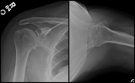 Anatomic Total Shoulder Arthroplasty