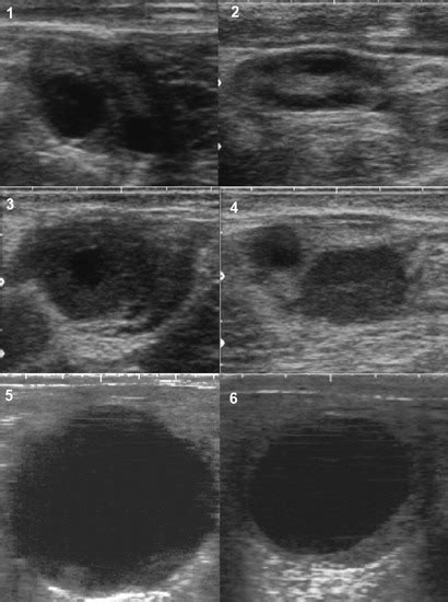 Ultrasound images of ovary. 1) Dominant follicle; 2) Cohort of ...