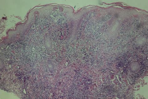 Difference Between Acanthosis and Acantholysis | Compare the Difference Between Similar Terms