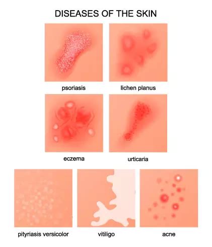 Details 131+ lichen planus nails home remedies latest - ceg.edu.vn