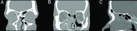 A paradigmatic case of monolateral pansinusitis after dislocation of a ...