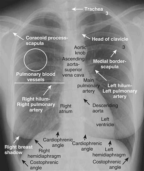 Anatomy Of Chest X Ray Ppt Chest X Ray Anatomy From One Another By ...