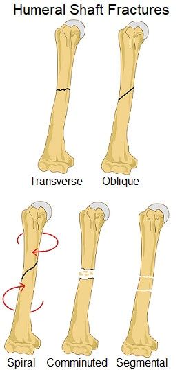 Humerus Fracture: Causes, Symptoms & Treatment