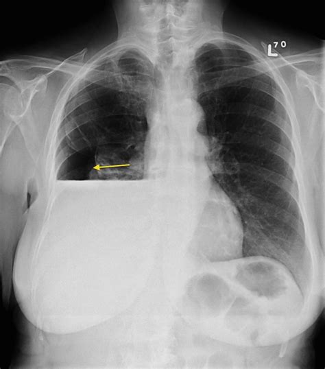 Hydropneumothorax - Radiology at St. Vincent's University Hospital