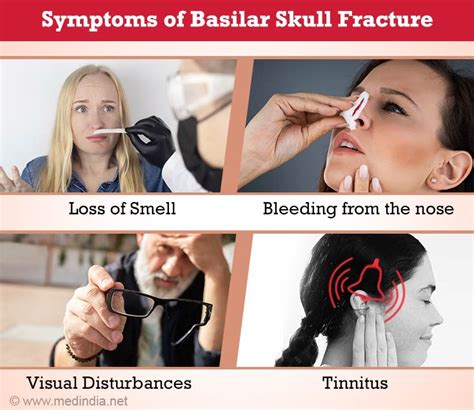 Skull Fractures – Types, Symptoms, Signs, Diagnosis, Treatment & Health Tips