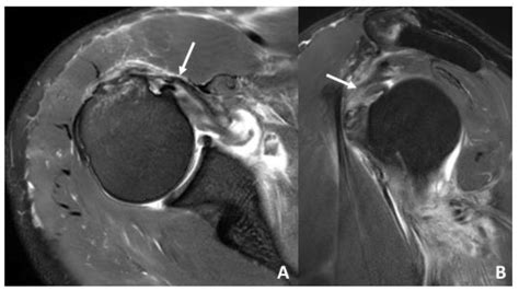 Mri Shoulder Dislocation