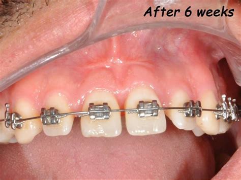 Labial frenectomy with Nd:YAG laser and conventional surgery