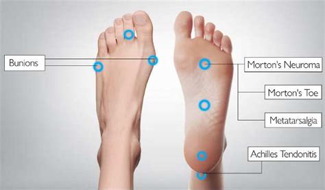 Diagram Of Foot Pain Areas