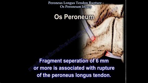 Peroneus Longus Tendon Rupture Os Peroneum Injury - Everything You Need To Know - Dr. Nabil ...