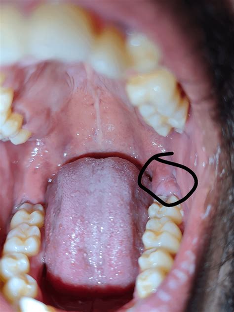 Wisdom tooth infection help please : r/wisdomteeth