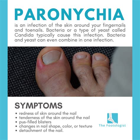 The Footologist - Paronychia is the most common nail...