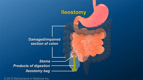 What is an Ileostomy?