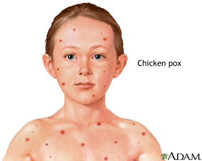 Chickenpox - Chickenpox