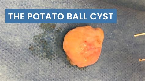 The "Potato Ball" Cyst (Whole Sac Removed) - Pimplepopping.tv