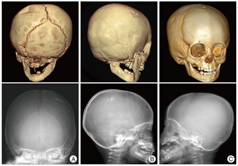 Simple Skull Fracture