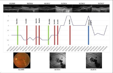 Figure 1 from Long-term results of intravitreal bevacizumab and dexamethasone for the treatment ...