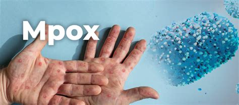 Mpox | Communicable Diseases | Health & Senior Services