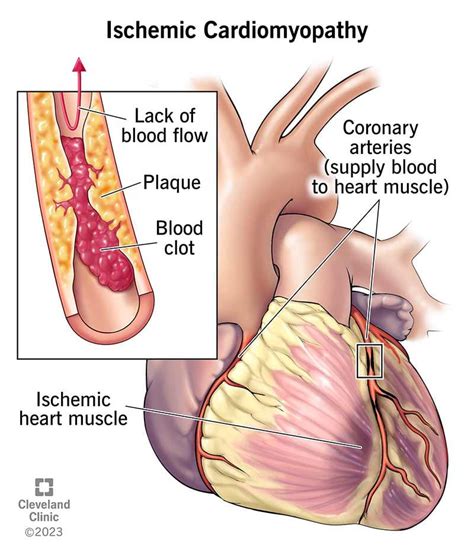 Ischemic Cardiomyopathy: Symptoms & Causes