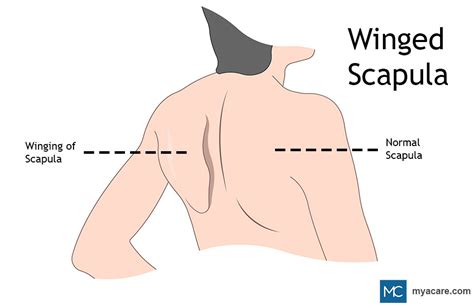 WINGED SCAPULA: CAUSES, SYMPTOMS, DIAGNOSIS AND TREATMENT | Mya Care