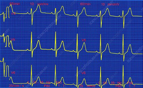 Normal heartbeat, ECG - Stock Image - M460/0140 - Science Photo Library