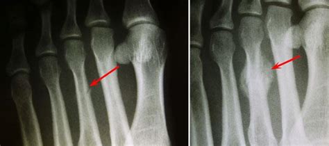 Toe and Forefoot Fractures - OrthoInfo - AAOS