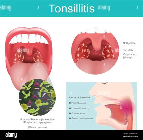 Uvulitis Explained: What's Causing Your Swollen Uvula?, 47% OFF