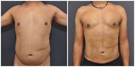 Liposuction Gone Wrong: Understanding The Risks And Realities