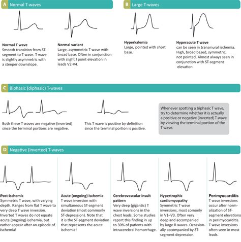 ECG interpretation: Characteristics of the normal ECG (P-wave, QRS complex, ST segment, T-wave ...