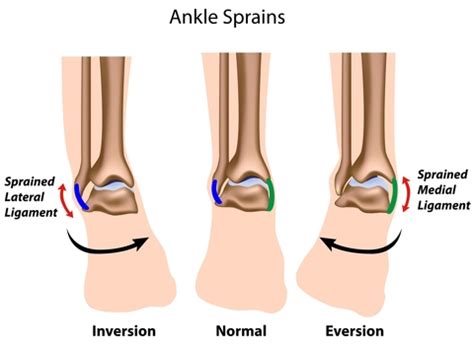 Deltoid Ligament Ankle Sprain التواء الكاحل بالرباط الدالي | Dubai Podiatry Centre