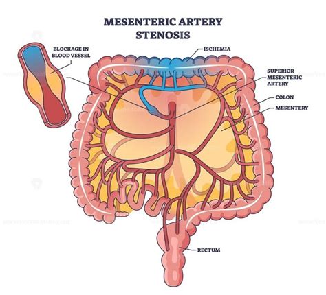 Mesenteric artery stenosis as blockage in blood vessel outline diagram – VectorMine