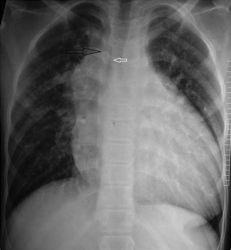 Right paratracheal mass on chest X-ray: an important part of the checklist before cardiac ...