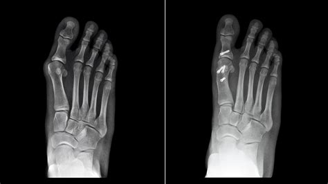 Do Bunion Surgery Techniques Outlive their Usefulness? Yes!