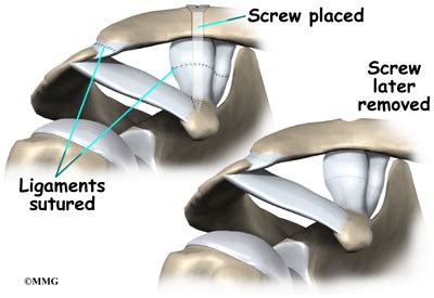 Acromioclavicular Joint Separation | Houston Methodist