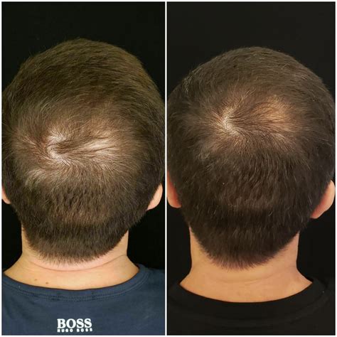 PRP Hair Restoration: How Does It Work, and Is It Permanent? - My Botox ...