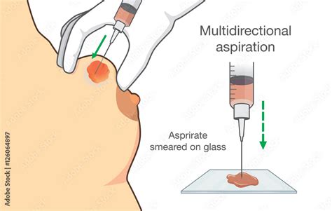 Drainage of breast cyst with needle for find breast cancer from sample. Illustration about ...