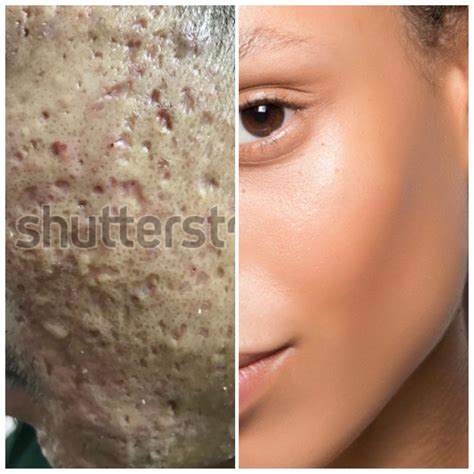 Before and after using The Ordinary Niacinamide 10% Zinc 1% for 2 (two) days : r/SCAcirclejerk