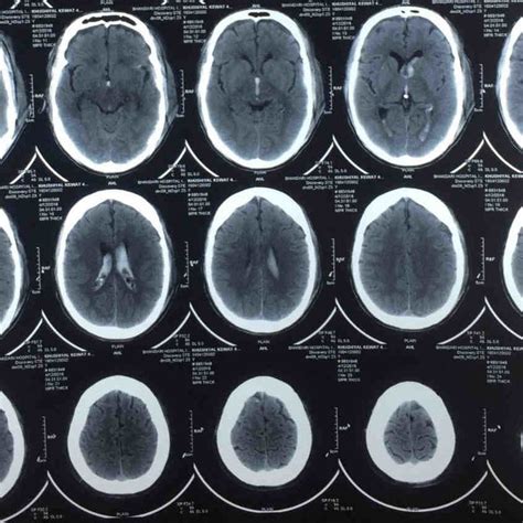 (PDF) Isolated traumatic intraventricular hemorrhage in adult with good prognosis