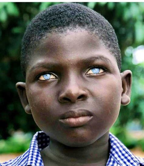 Ocular albinism - MEDizzy