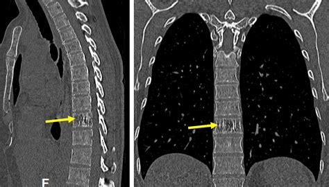 “Jail bar” sign of vertebral hemangioma – Radiology Cases