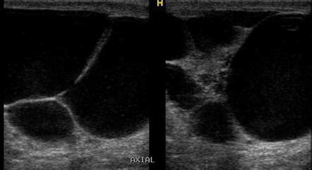 Spermatocele | Radiology Reference Article | Radiopaedia.org