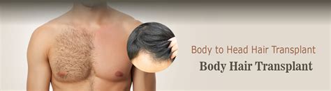 Body Hair Transplant in Hyderabad | Hair transplant | Microsurgclinics